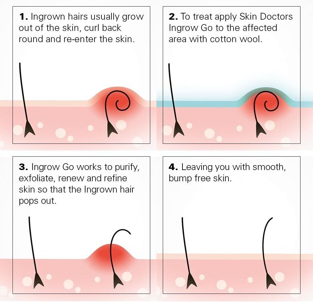 Skin Doctors Ingrow Go Say Goodbye to Ingrown Hairs with 120ml of Smooth Skin