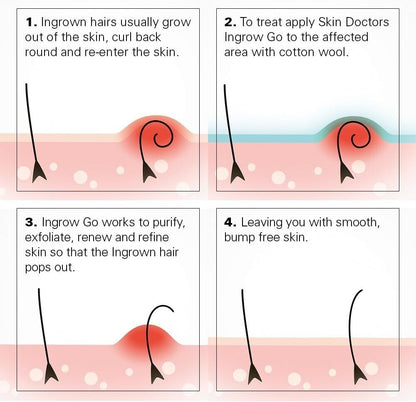 Skin Doctors Ingrow Go Say Goodbye to Ingrown Hairs with 120ml of Smooth Skin